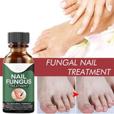 Fast Nail Fungal Treatments Nail Repair Essences Serum Care Treatments Foot Nail Fungus Removal Gel Paronychia Onychomycosis ValueKartPk