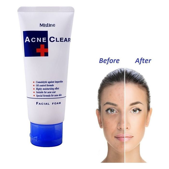 Acne Clear Facial Foam Wash, 85ml ValueKartPk